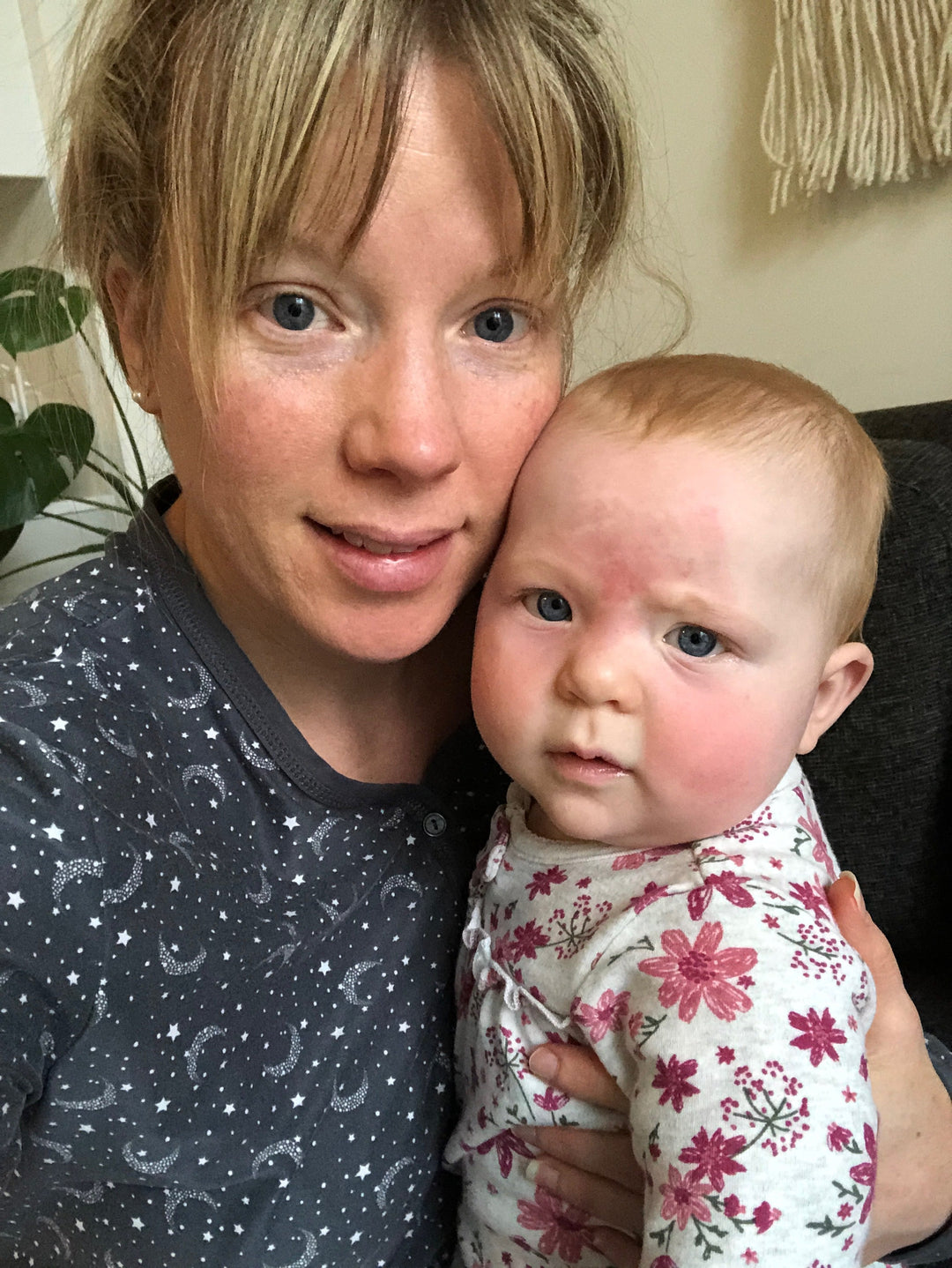 Sunburns Happen: What to Do If Your Baby Gets One